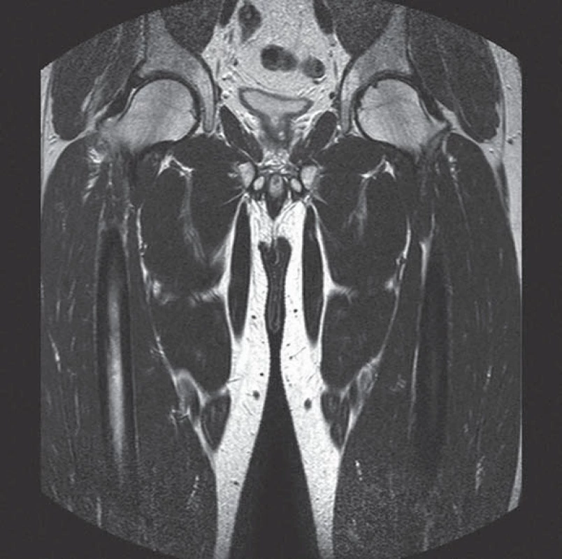 MRI kyčlí (srpen roku 2012). Na obou kyčlích je zcela normální obraz morfologie i signálních intenzit včetně sekvencí s potlačením tuku (v porovnání s CT vyšetřením v roce 2011, kdy byla popisována nepravidelně prořídlá struktura suspektní z časnější fáze aseptické nekrózy, na tomto snímku není prokazatelná; nelze zaznamenat ani ložiska dřeňového edému).
