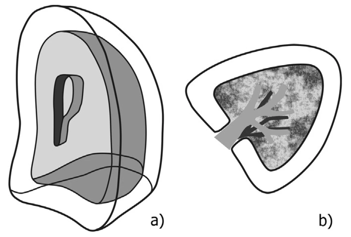Schéma anatomie pohrudniční dutiny – uspořádání obou listů pleury: a) zevní pohled, b) transverzální řez v rovině plicního hilu 
Fig. 1: Diagram of the pleural cavity anatomy – arrangement of both layers of the pleura: a) external view, b) transversal cross-section at the level of the lung hilum