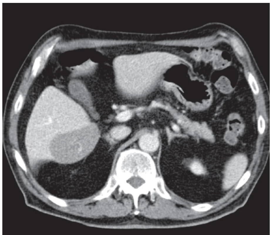 CT nález – tumorozní ložisko při dolním okraji jater
Fig. 1: CT findings – tumour at the lower margin of the liver