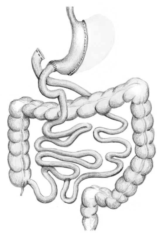 Biliopankreatická diverze typu duodenal switch
Fig. 6: Biliopancreatic diversion – duodenal switch