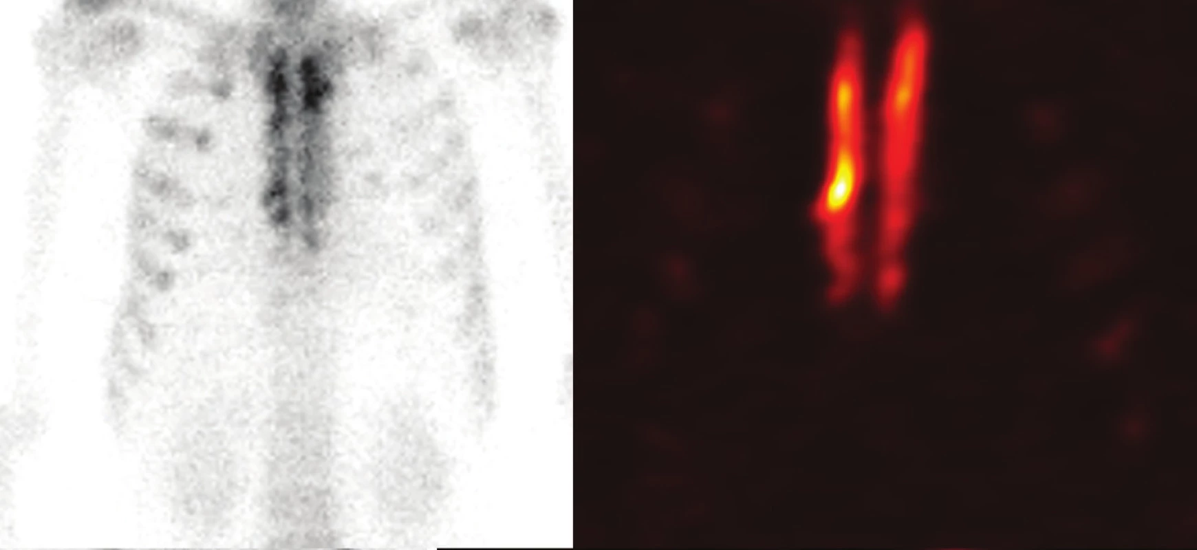 Celotělová planární scintigrafie (A) a SPECT (B) hrudní stěny 18 měsíců po transplantaci kostního štěpu sterna
Fig. 3: Whole-body planar scitigraphy (A) and SPECT (B) 18 months after the transplantation of the sternal bone graft