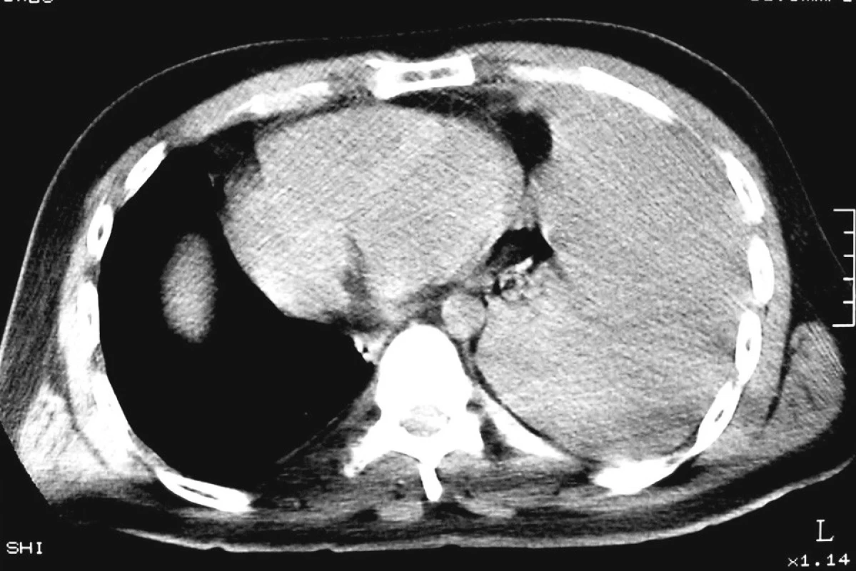 CT hrudníku, levostranný hemotorax 
Fig. 4. CT of chest, haemothorax on the left side