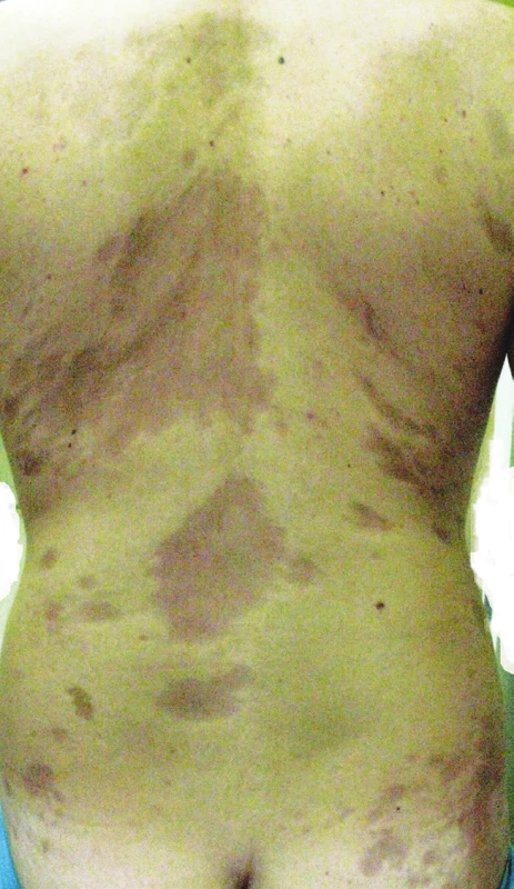 Atrophodermia idiopathica