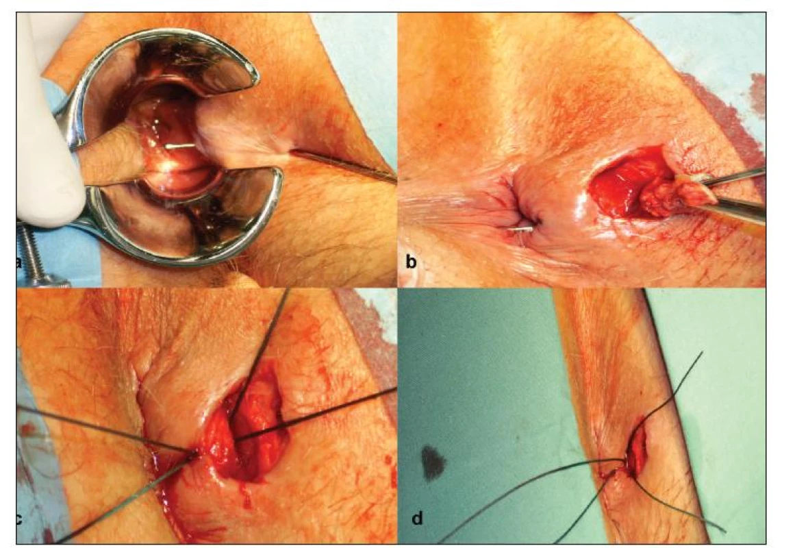 a) Sondáž píštěle, b) Excize zevního traktu píštěle, c) Protažení elastické a trasovací ligatury, d) Dotažení elastické ligatury
Fig. 2. a) Fistula probing, b) Excision of the external fistula tract, c) Elastic and tracking ligature, d) Elastic ligature fastening