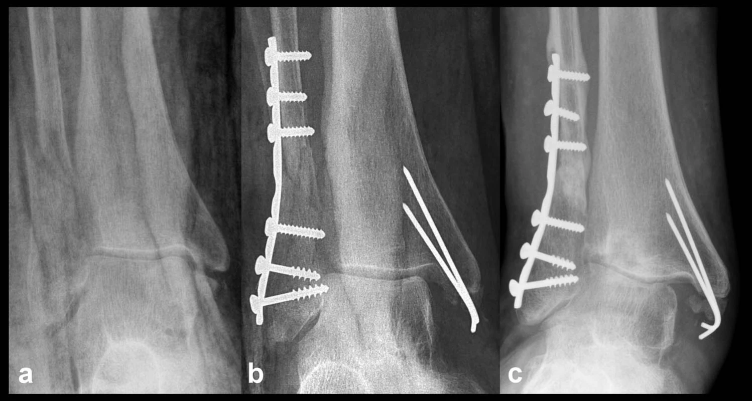 Nesprávné ošetření osteo-ligamentózního poranění mediálních struktur a – na rtg patrné odlomení předního kolikulu, b – snímek po operaci, fibula fixována ve valgozitě, talus nezreponován a zůstává subluxován, přestože přední kolikulus byl reponován a přichycen K-dráty, c – výrazná progrese subluxace za 6 měsíců po operaci
