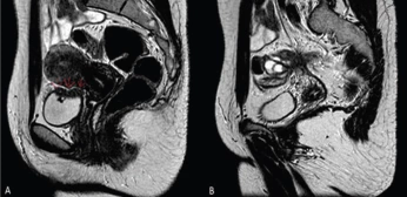 Sagittal T2-weighted MRI with contrast medium showing hypointense tissue protruding into the lumen as per endometriotic localization at the level of the bladder dome (red arrows) (A). Sagittal T2-weighted MRI with contrast medium. Note the deep pelvic endometriosis (stage IV, AFS and ASRM classifi - cation) involving the round ligament, the ovaries and the sigma (B).
