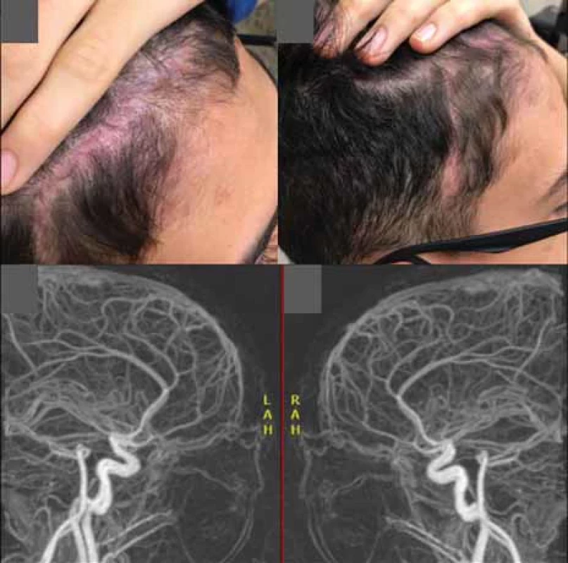 A, B) Figures showing late postoperative appearance of the surgical wound. C, D) Figures showing postoperative arteriography without signs of residual fl ow.