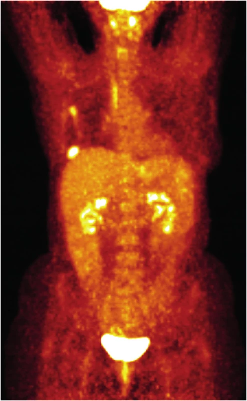 PET/CT vyšetření v dubnu 2013
Fig. 6: PET/CT scan in April 2013