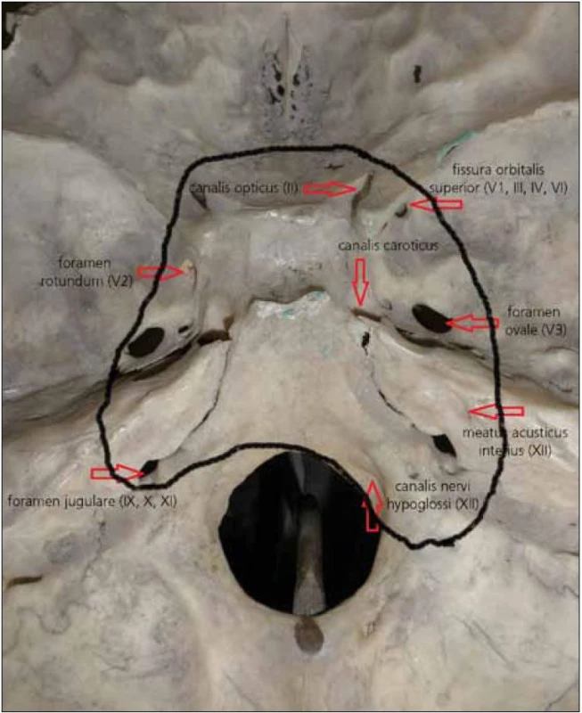 Přibližná, konečná infiltrace baze lební, včetně neuroforamin a příslušných hlavových nervů.