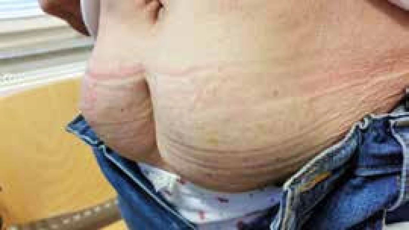 Lipohypertrofická tkáň