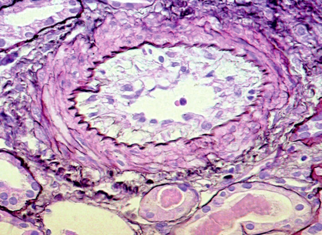 Svalová arterie malého kalibru se stenózující intimální mukoidní hyperplazií 
(barvení PASM [periodic acid – silver methenamine]; objektiv 40krát)
