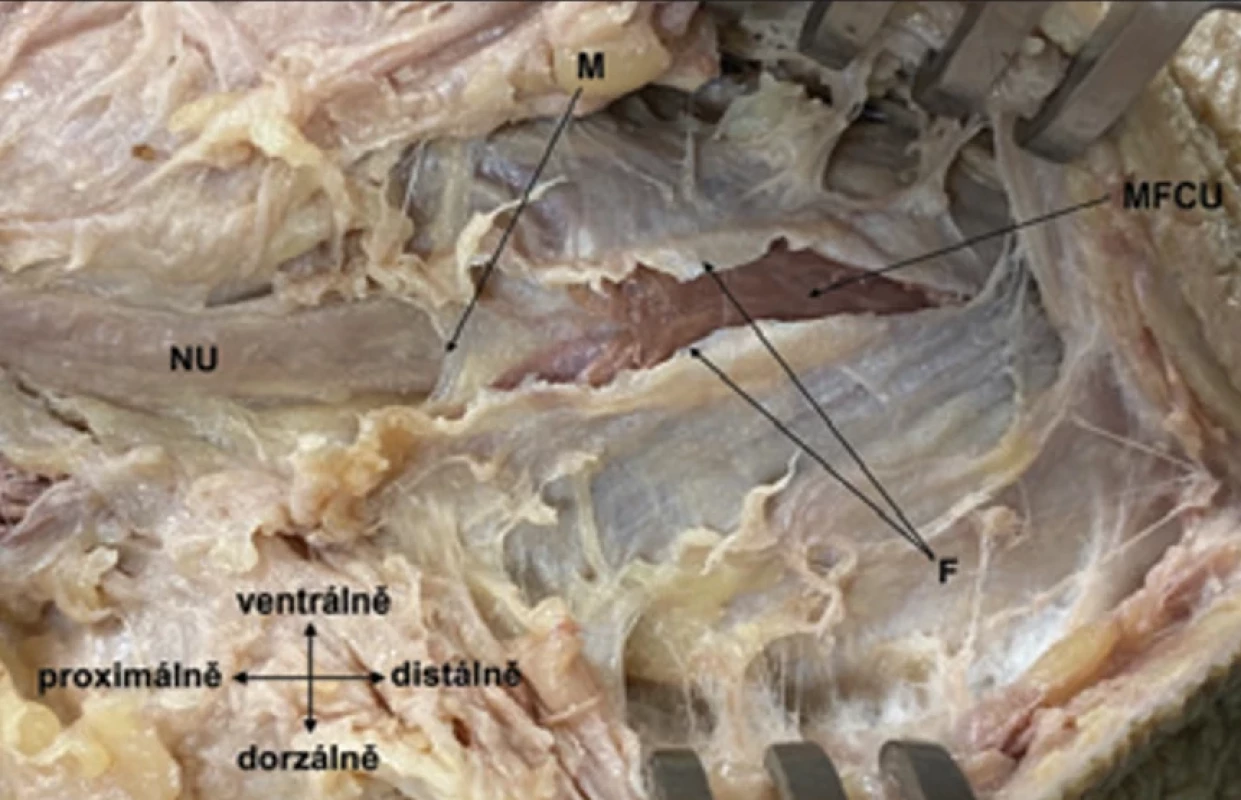Protnutá povrchová fascie musculus fl exor carpi ulnaris (černá šipka) a proximální  okraj submuskulární membrány přímo naléhající na nervus ulnaris.  Fig. 7. Severed superfi cial fascia of the musculus fl exor carpi ulnaris (black arrow) and the  proximal edge of the submuscular membrane directly adjacent to the nervus ulnaris.