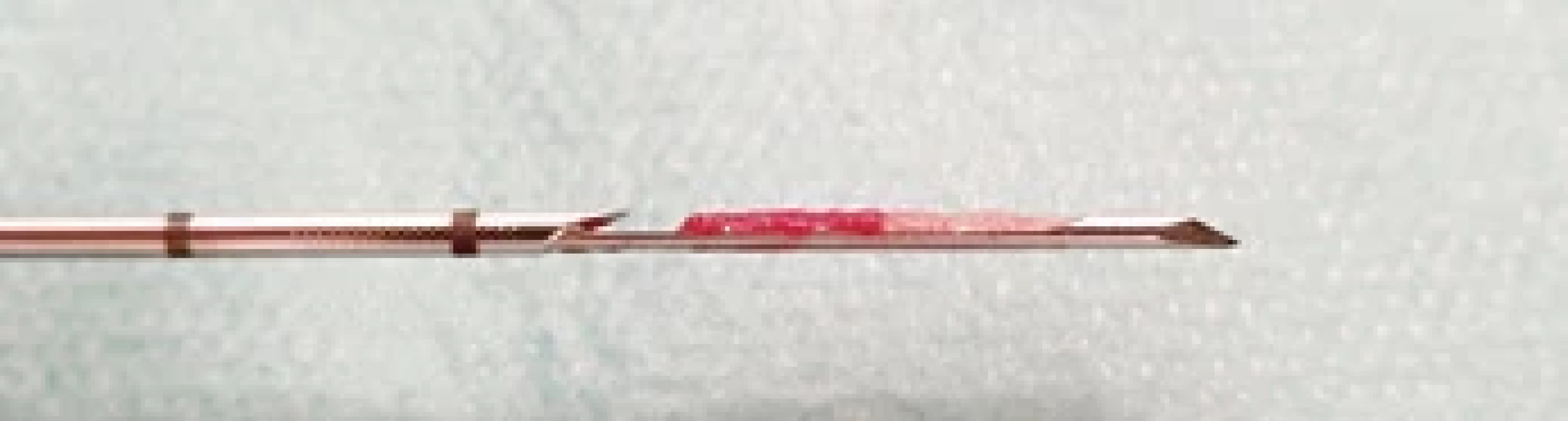 Detail hrotu bioptické jehly kalibru 16 G se vzorkem tkáně metastázy maligního melanomu v příušní žláze – diagnostický vzorek.Detail of the tip of the core-needle (16 Gauge) with sample of metastasis of malignant melanoma into the parotid gland – a diagnostic sample.