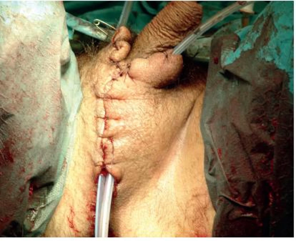 Pooperační snímek
Fig. 3. Postoperative foto