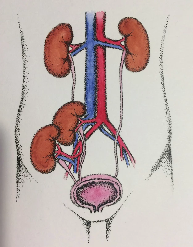 Jednostranná technika DKT
Fig. 1: Unilateral technique of DKT
(kresba MUDr. Táňa Matoušková)