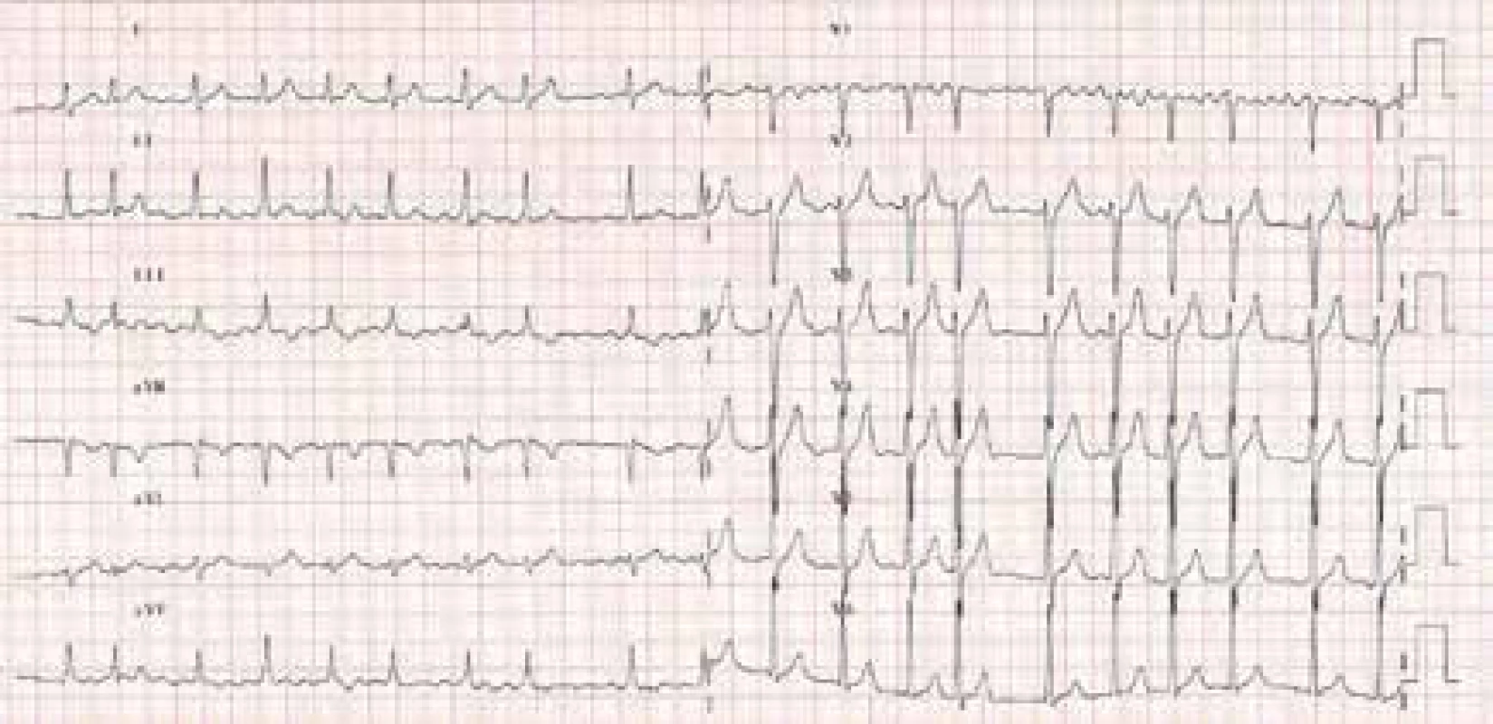 EKG obraz fibrilace síní