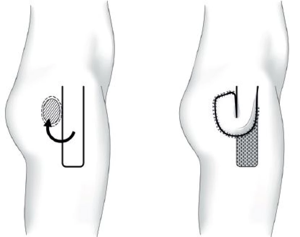 Trochanterický dekubitus – fasciokutánní lalok m. tensor fasciae latae
Fig. 3: Trochanteric pressure ulcer – tensor fasciae latae fasciocutaneus flap