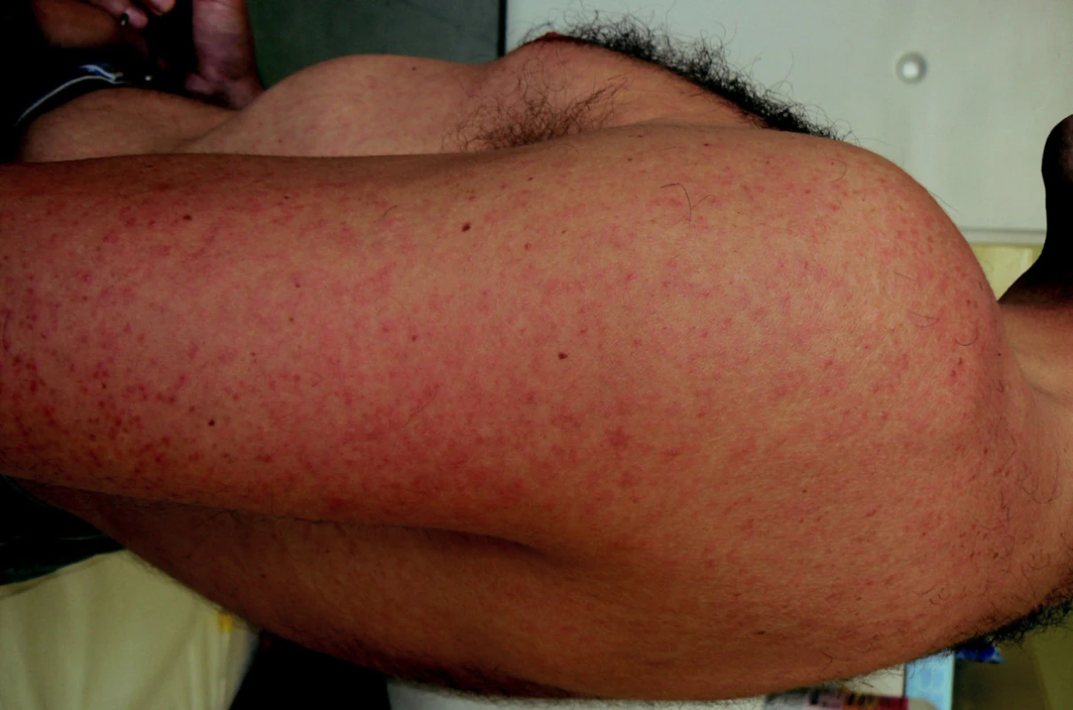Exantém při horečce dengue