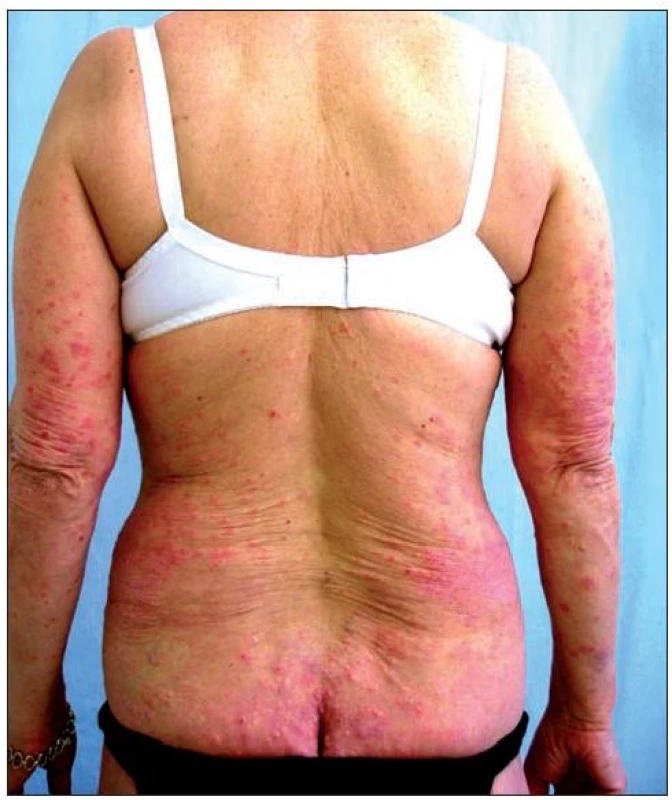 Obraz těžké formy chronické ložiskové psoriázy – stav před zahájením terapie etanerceptem