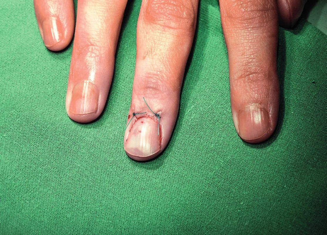 Nail re-fixation