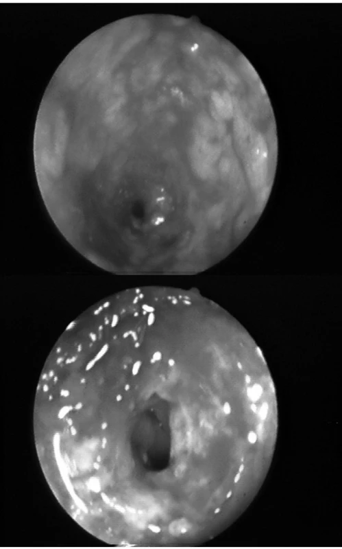 a, b. Endoskopický nález. Pohled do těsné stenózy rektosigmoideálního přechodu, ulcerace,
krvácení.
Fig. 1a, b. Endoscopic finding. A view of narrow stenosis of rectosigmoid transition, ulceration, bleeding.