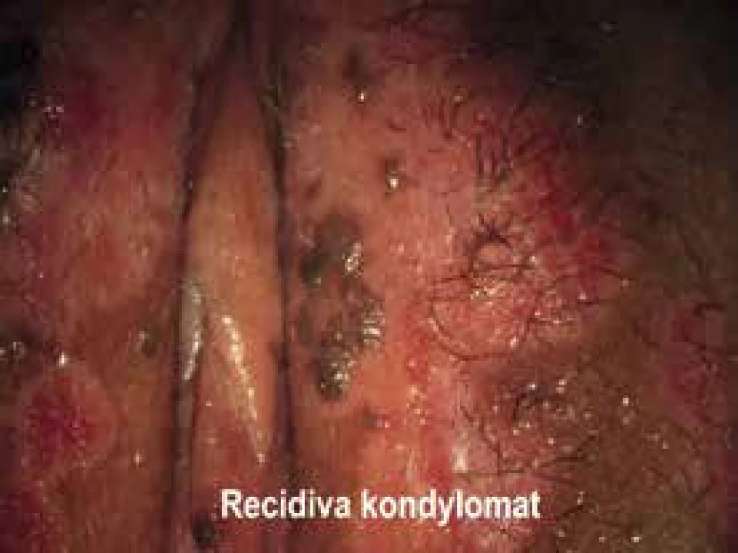 Recidiva kondylomat