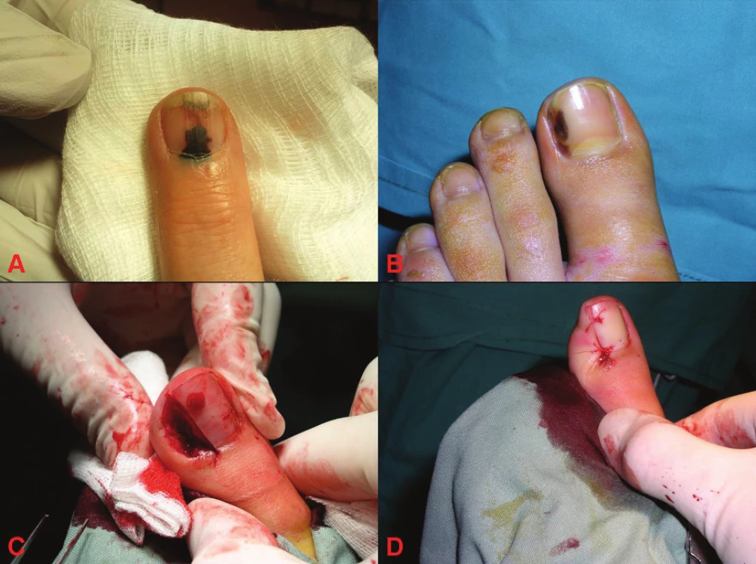 Subunguální hematom a subunguální melanom
A: subunguální hematom
B: subunguální melanom
C: peroperační snímek diagnostické excize subunguálního melanomu
D: stav po provedené diagnostické excizi subunguálního melanomu, po které následovala amputace prstu