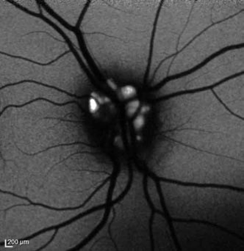Fundus autoflorescencia (Spectralis) pravé oko (pacient č. 2).
