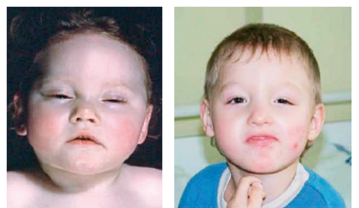 a, b. Pacienti se syndromem DEND.<br>
Fig. 1. a, b. Patients with DEND (Developmental delay, Epilepsy
and Neonatal Diabetes) syndrome.