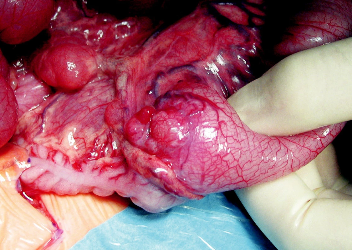 Peroperačný obraz dilatovaného ilea a hypoplastického colon s palpovateľným intraluminálnym tumorom v ileocekálnej oblasti
Fig. 3. Peroperative view of dilatation of the ileum and hypoplastic colon with a palpable intraluminary tumor in the ileocecal region