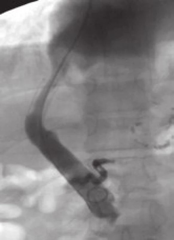 Pseudointimální hyperplazie v intraparenchymové části zkratu (dva roky po zavedení TIPS).
Fig. 5. Pseudo-intimal hyperplasia in intraparenchymal part of the shunt (two years after the introduction of TIPS).