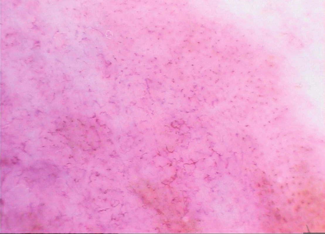 Tenký melanom (Breslow 0,1 mm)
Dermatoskopický obraz je kombinací převažujících tečkovitých cév s nepravidelnými lineárními ektaziemi.