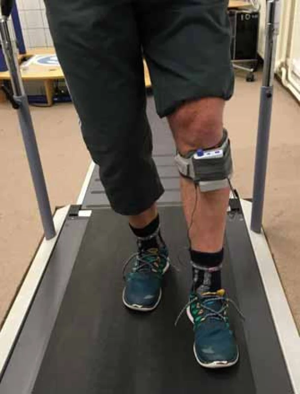 Funkční peroneální neurostimulátoru přístrojového systému WalkAide.
Fig. 1. Functional electrical stimulation of peroneal nerve with WalkAide neurostimulator.