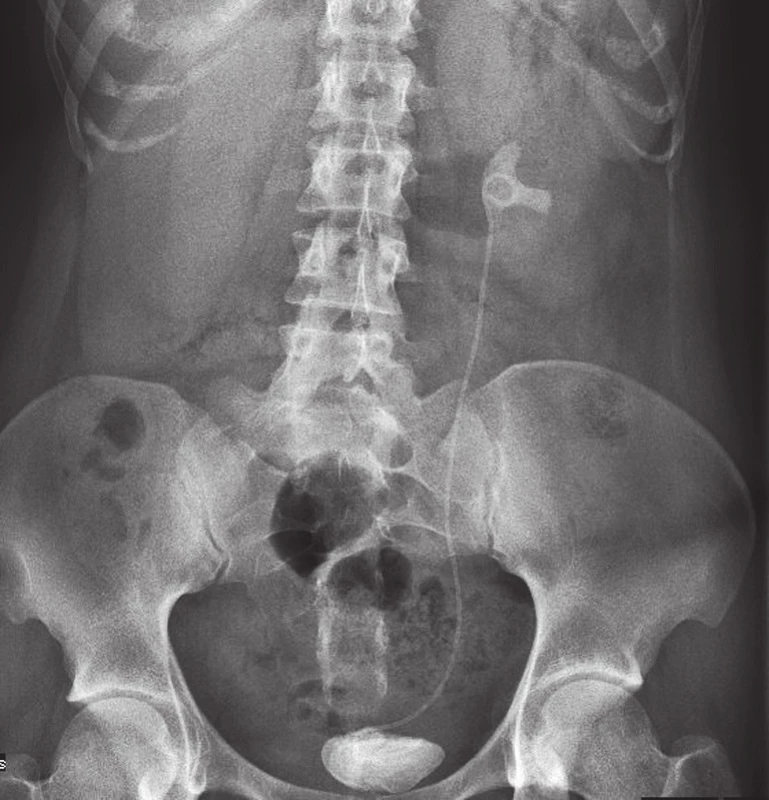 Nefrogram – inkrustovaný proximální i distální konec stentu v levé ledvině
Fig. 1. Plain-film radiography – incrusted proximal and distal part of the stent in left kidney