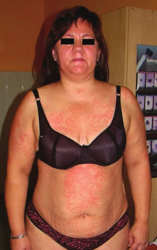DRESS syndrom po eslikarbazepinu
