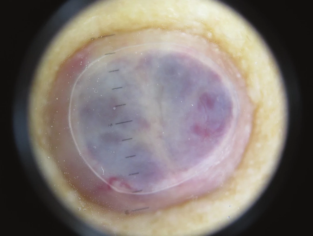 Dermatoskopický obraz v nepolarizovaném světle