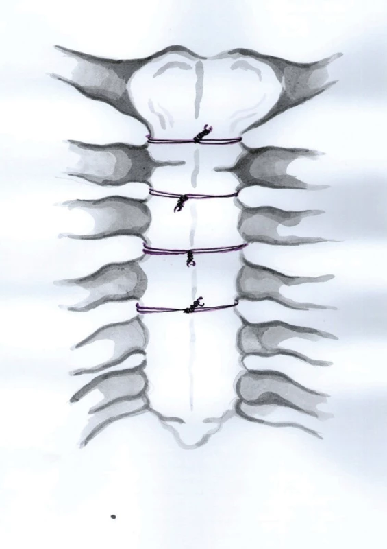 Technika uzávěru sternotomie dvojitými polydioxanonovými stehy (Kresba archiv autora)
Fig. 1: Sternal closure with PDS loop