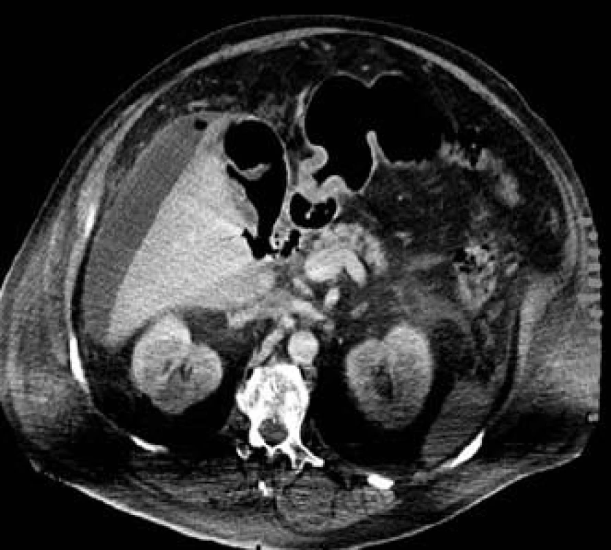 Obraz ohraničené nejspíše kryté perforace v oblasti D1.
Fig. 1. CT-cross imaging section proved the subhepatic cavity with gaseous filling.