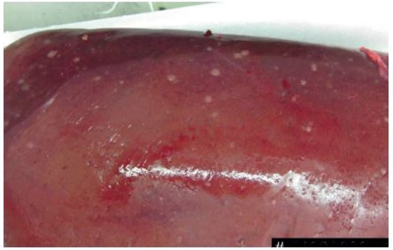 Resekovaný preparát pravostranné hemihepatektomie
Fig. 4: Resected liver – right hemihepatectomy