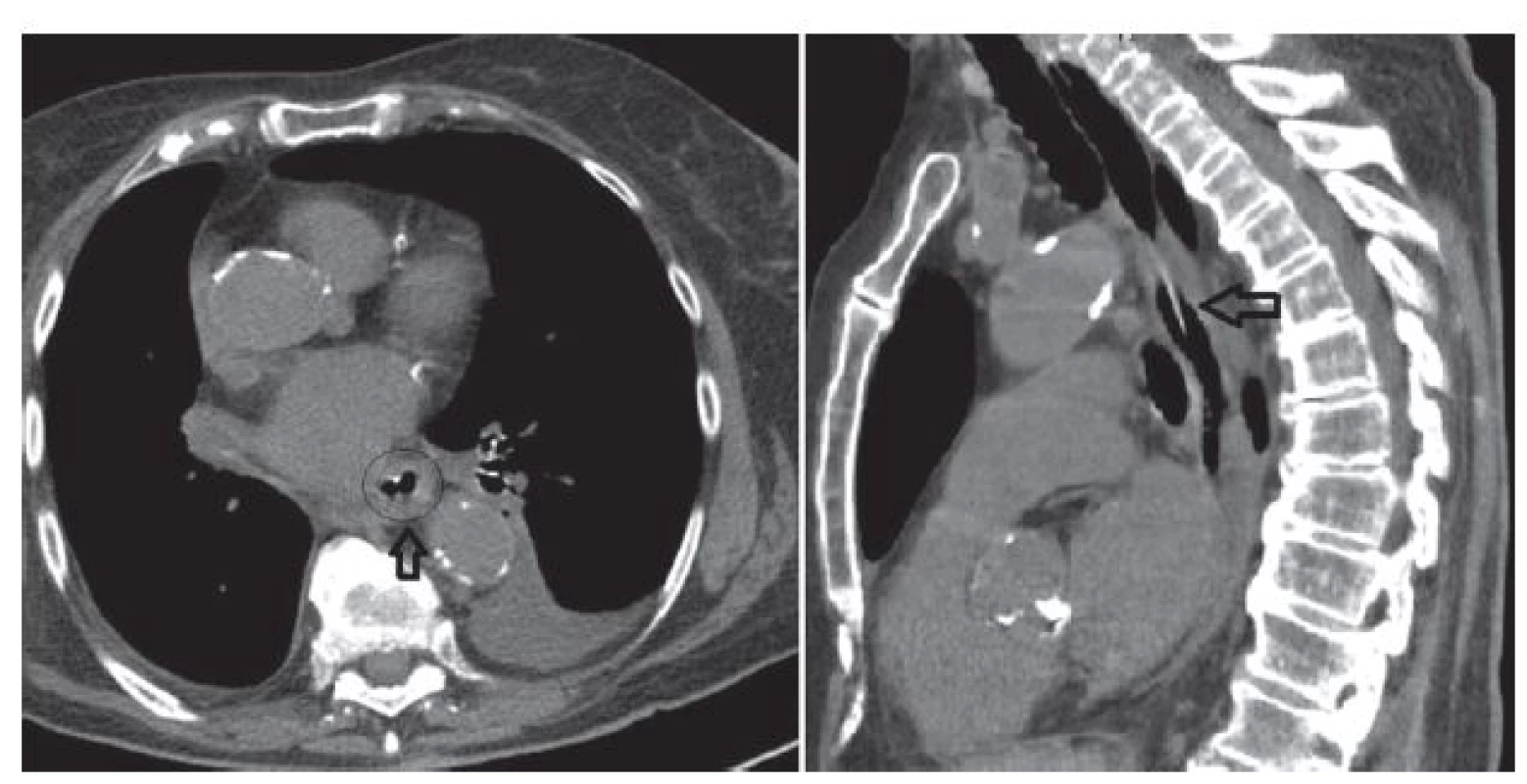 <b>CT po 13 dnech, transversální a sagitální řez</b>
Šipka označuje jícen bez hematomu s přiměřeným lumen.
<b>Fig. 3: CT after 13 days, transversal and sagittal cross-section</b>
The arrow indicates the oesophagus without haematoma with adequate lumen.