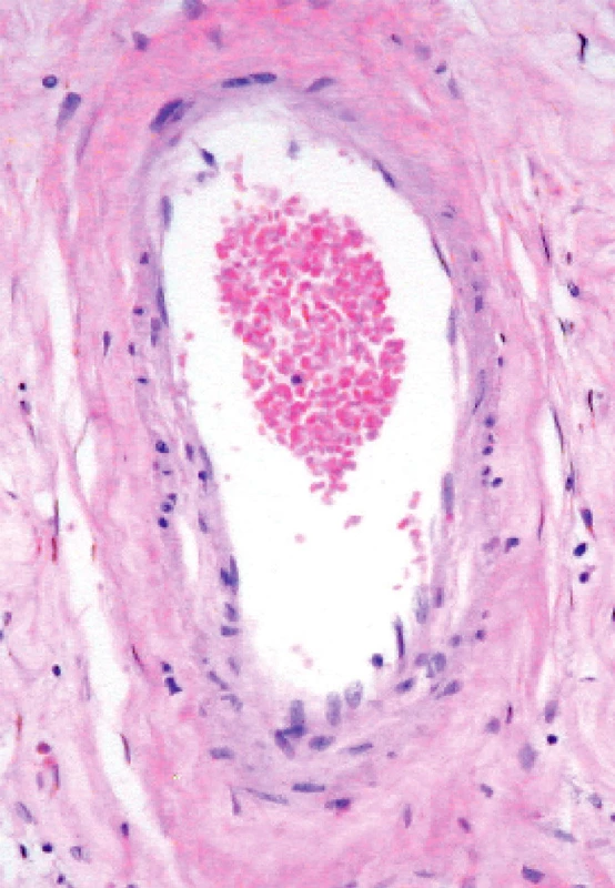 Charakteristické poškození mozkové tepénky pfii CADASIL. Stejné poškození se dá zachytit v kožní biopsii, kde lze dospět k jednoznačné diagnóze imunohistochemické
užitím protilátky proti receptoru Notch-3. (Zv. x 200, barveno H.E.)