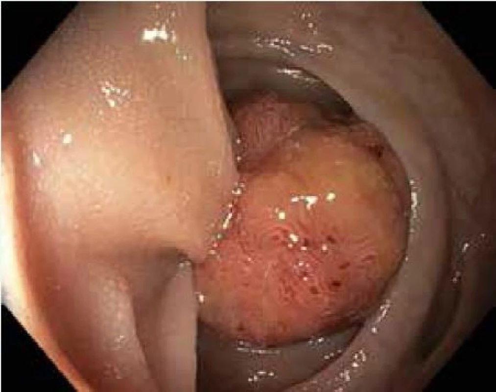 Stopkatý polyp sigmatu 20 mm, Ip