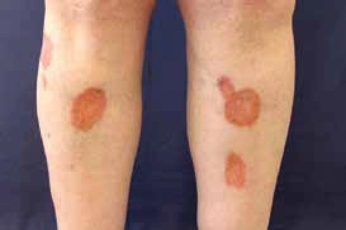 Necrobiosis lipoidica