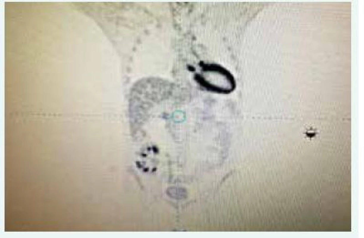 PET-CT vyšetrenie – diagnostika infekčnej endokarditídy. 