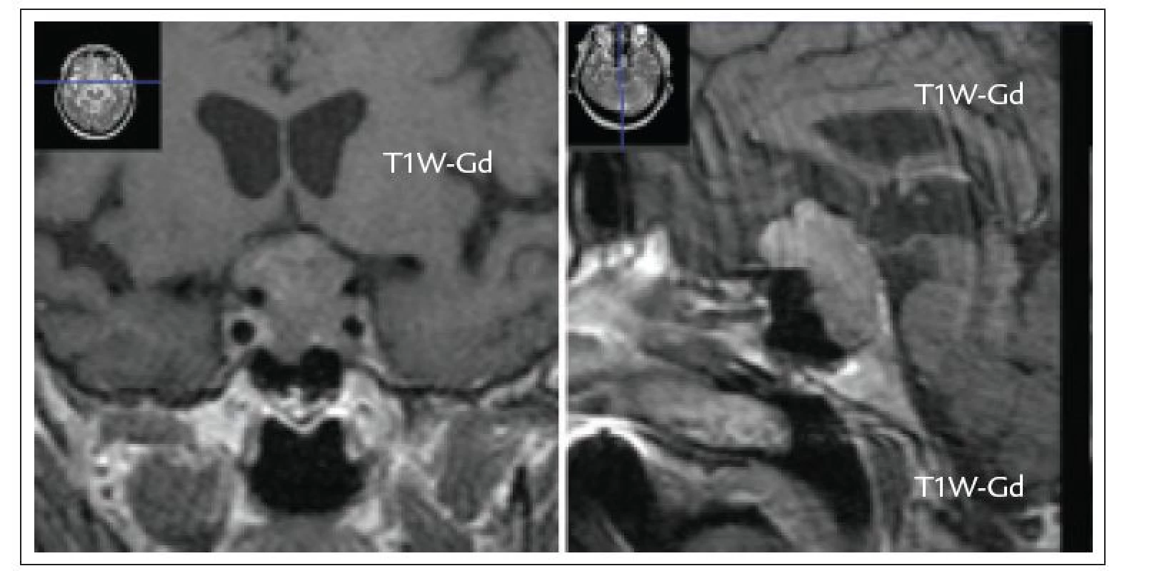 a. MRI nález 72leté pacientky, u které byl zjištěn objemný hormonálně afunkční adenom hypofýzy s extraselární propagací při vyšetření pro úraz hlavy po pádu.
