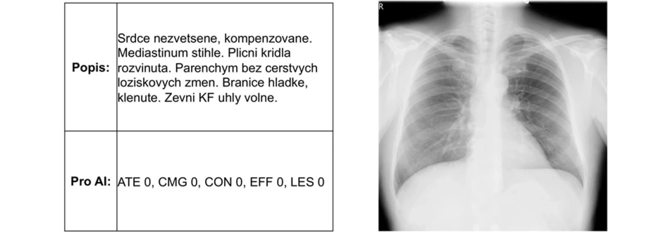 Původní negativní rtg snímek hrudníku a odpovídající popis hodnotícího lékaře verifikovaný seniorním radiologem z Nemocnice Tábor, použitý jako referenční standard pro porovnání s výsledky algoritmu Carebot AI CXR a hodnocením lékařů v multi-reader studii