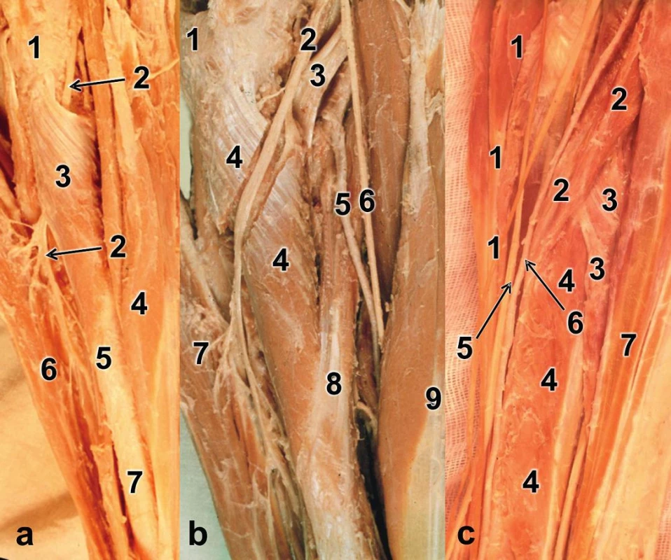 Začátky a úpony svalů na radiu (preparát pravé strany): a – proximální polovina radia, 
1 – kloubní pouzdro kryjící hlavici radia, 2 – r. profundus n. radialis, 3 – m. supinator, 4 – m. flexor carpi radialis, 5 – úpon m. pronator teres, 6 – m. extensor digitorum,  7 – diafýza radia; b – proximální polovina radia s vypreparovným canalis supinatorius, 1 – kloubní pouzdro kryjící hlavici radia, 2 – r. profundus n. radialis, 3 – šlacha m. biceps brachii, 4 – m. supinator s vypreparovaným canalis supinatorius, 5 – a. radialis odtažená mediálně, 6 – r. superficialis n. radialis odtažený mediálně, 7 – m. extensor digitorum, 8 – m. pronator teres, 9 – m. flexor carpi radialis; c – střední třetina radia, 1 – m. brachioradialis, 2 – m. pronator teres, 3 – m. flexor digitorum superficialis (caput radiale), 4 – m. flexor pollicis longus, 5 – r. superficialis n. radialis, 6 – a. radialis, 7 – m. flexor carpi radialis.
Fig. 5: Muscle origins and insertions on radius (right side specimen): a – proximal half of radius, 
1 – joint capsule enveloping radial head, 2 – deep branch of radial nerve, 3 – supinator, 4 – flexor carpi radialis, 5 – insertion of pronator teres, 6 – extensor digitorum, 7 – radial shaft; b – proximal half of radius with dissected canalis supinatorius, 1 – joint capsule covering radial head, 2 – deep branch of radial nerve, 3 – biceps brachii tendon, 4 – supinator with dissected canalis supinatorius, 
5 – radial artery retracted medially, 6 – superficial branch of radial nerve, 7 – extensor digitorum, 
8 – pronator teres, 9 – flexor carpi radialis; c – the middle third of radius, 1 –  rachioradialis, 
2 – pronator teres, 3 – flexor digitorum superficialis (radial head), 4 – flexor pollicis longus, 
5 – superficial branch of radial nerve, 6 – radial artery, 7 – flexor carpi radialis.