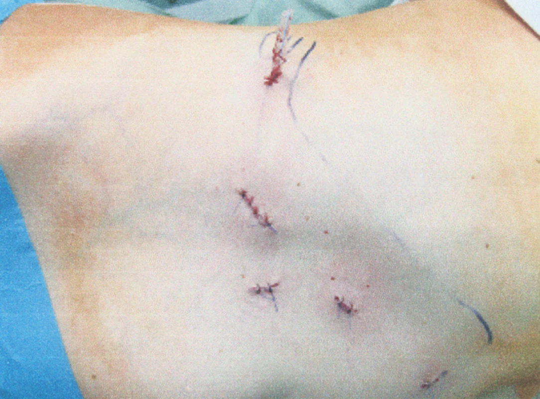 Fotografie břišní stěny po pravostranné laparoskopické adrenalektomii. Je patrno 5 vstupů, v laterálním je kapilární drén, druhý nejlaterálnější byl lehce rozšířen a užit k extrakci preparátu
Fig. 5. View of the abdominal wall following laparoscopic adrenalectomy on the right. 5 ports are visible. A capillary drain is inserted into the lateral one, while the second lateral one is slightly widened and used for extraction of the specimen