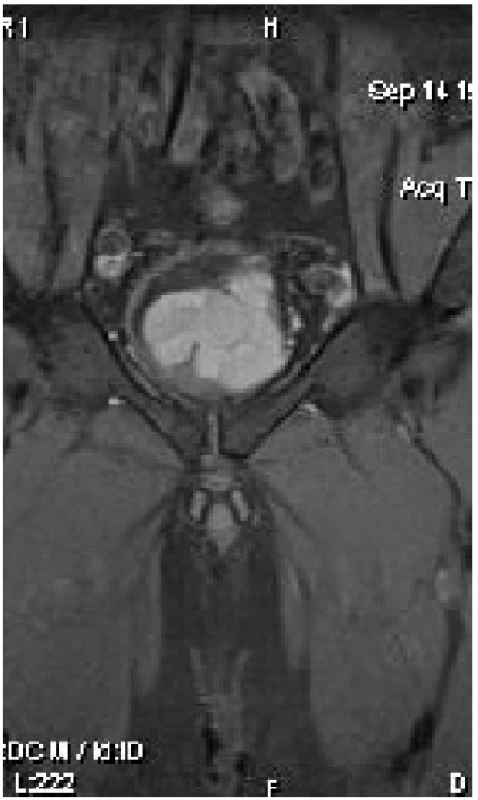 MRI koronární řez – cystický nádor prostaty
Fig. 2 MRI coronal plane – cystic tumor of prostate