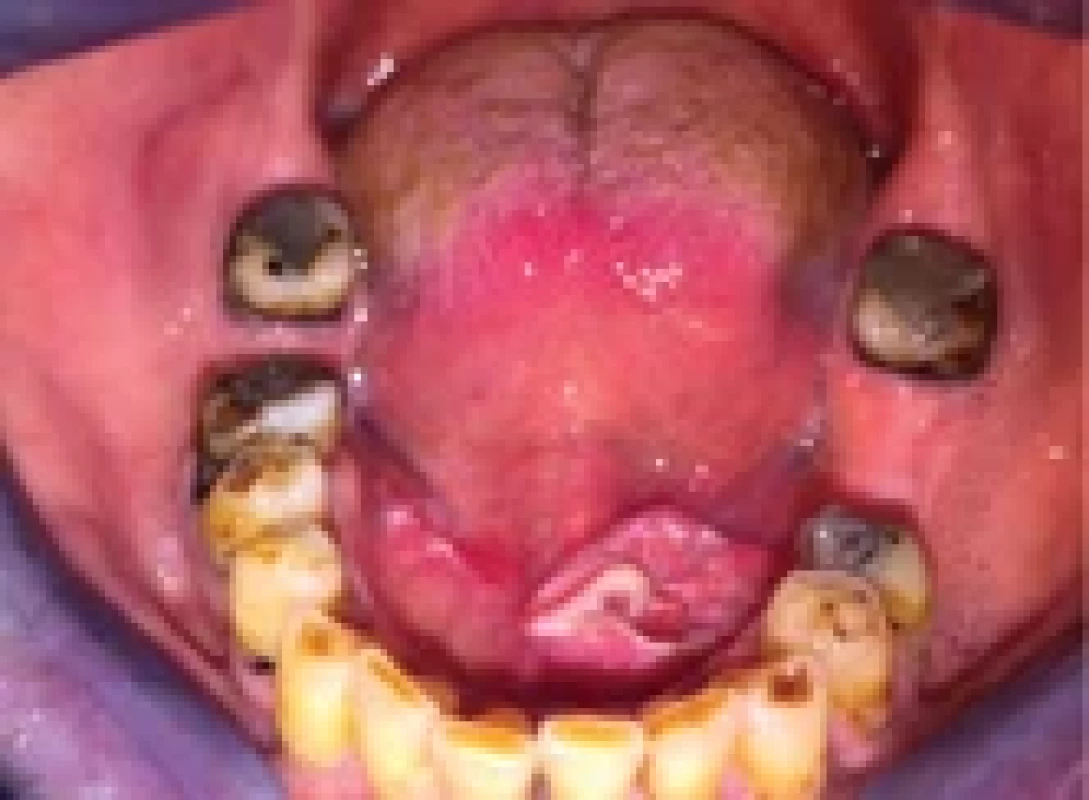 Squamous cell carcinoma – fl oor of the mouth left.